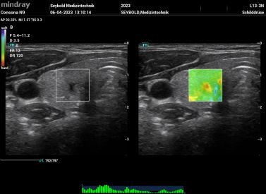 Kompressions-Elastographie von mindray