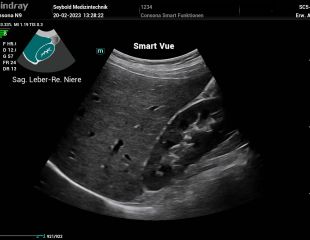 Smart Vue - mindray ultraschallgerät