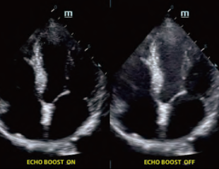 Echo Boost-mindray Ultraschallgerät