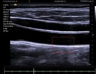 Arterial-Health-Package-siemens ultraschallgerät