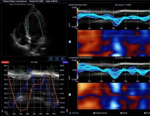 Cube-Strain_alpinion-ultraschallgerät_kardiologie