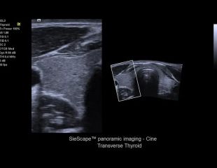 SieScape panorama Bildgebung von Siemens Ultraschallgerät