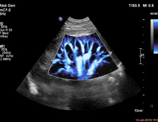 Micro Flow Imaging von Philips Ultraschallgerät