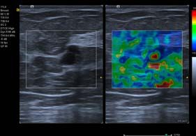 eSie Touch Elastographie - Kompressions-Elastographie von Siemens