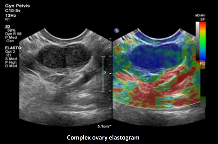 Elastographiemessung am Ovar, Philips Ultraschallgeräte